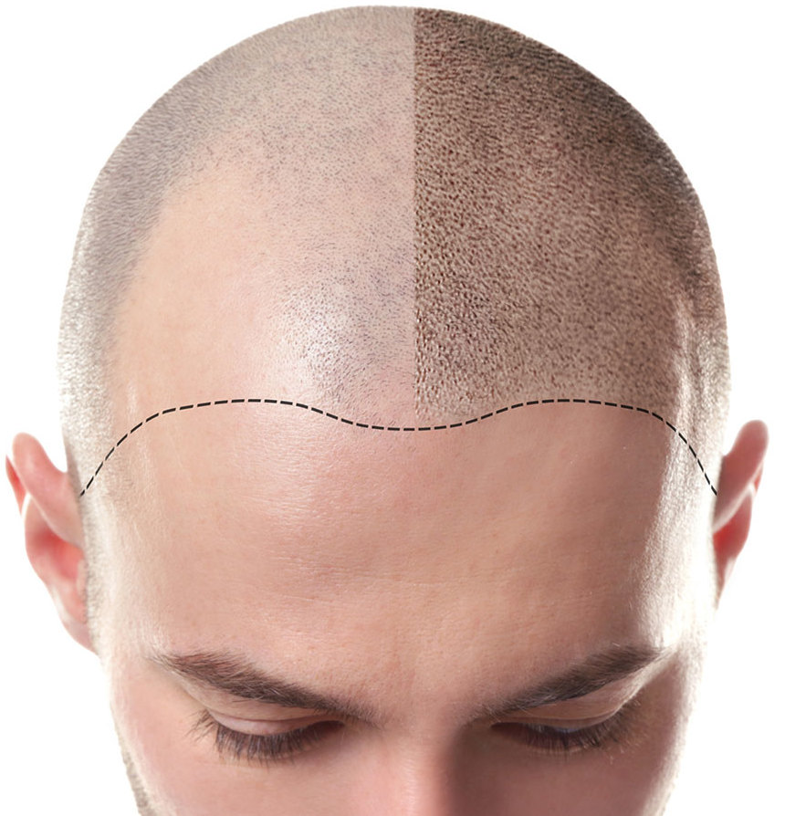 scalp micropigmentation